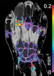 Ktrans map of the hand
